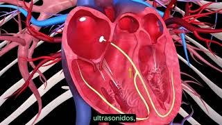 Cardiopatía isquémica [upl. by Artinahs]