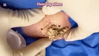 Big Cystic Acne Blackheads Extraction Blackheads amp Milia Whiteheads Removal Pimple Popping [upl. by Nicol817]