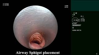 Hemoptysis Bronchoscopic endobronchial sphigot  Watanabe  placement with Glue instillation [upl. by Bowerman]