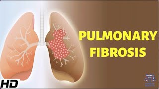 Pulmonary Fibrosis Everything You Need To Know [upl. by Nichy]