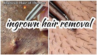 ingrown hair removal  tiktok compilation [upl. by Hoehne690]