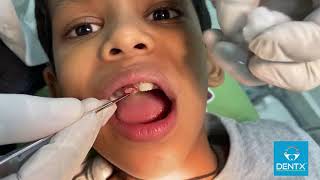 DrKiranKoora Pediatric Dentist  Operculectomy Procedure [upl. by Jaqitsch252]