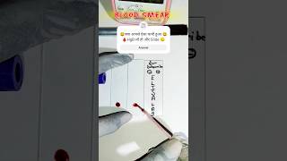 😞Blood Smear Preparation 🩸bloodsmear shortsvideo laboratory medical [upl. by Eramat175]