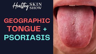 What is Geographic Tongue Is It a Sign of PSORIASIS  Jennifer Fugo [upl. by Rowland523]