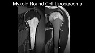 Myxoid Round Cell Liposarcoma [upl. by Holzman]