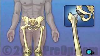 Hip Replacement Surgery [upl. by Jennilee386]