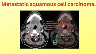 metastatic squamous cell carcinoma of tongue [upl. by Eidna]