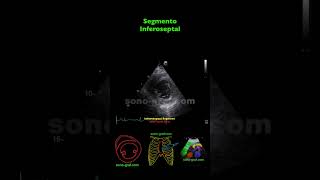 Ecocardiografía  Hipocinesia Inferolateral E Inferior [upl. by Luella199]