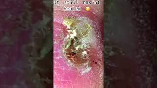 Blackheads loan nguyen 2022  Cystic acne and blackheads removal [upl. by Angelita331]