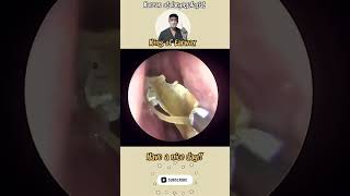 rhinorrhea sinusitis bersihkankuping satisfyingvideos pembersihan telinga video puas hati [upl. by Boehike]