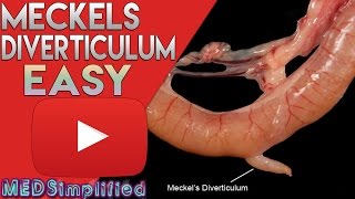 Meckels Diverticulum Made Easy [upl. by Asi]