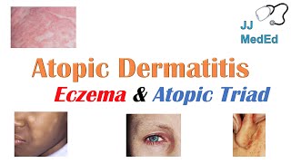 Eczema Atopic Dermatitis  Atopic Triad Triggers Who gets it Why does it happen amp Treatment [upl. by Shuler126]