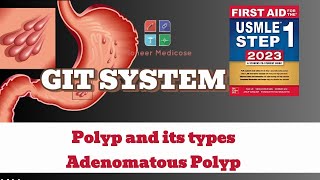 USMLE Step1 Polyp and its types Adenomatous Polyps from first aid step 1USMLEUrduHindi [upl. by Icul]