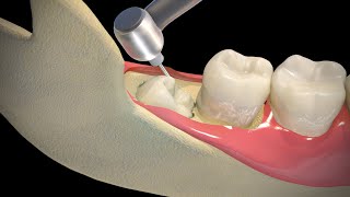 Wisdom Teeth Extraction  Step by step [upl. by Peterman]