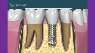 Periimplantitis y sobrecarga en implantes [upl. by Rocher675]