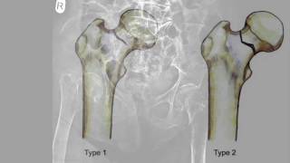 Femoral neck insufficiency fracture [upl. by Ahsenav858]