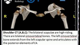 Sprengel Deformity [upl. by Hazaki]