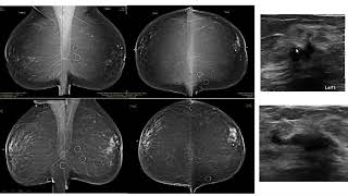 Lobular Carcinoma In Situ and High Risk Breast Lesions [upl. by Ettelloc]