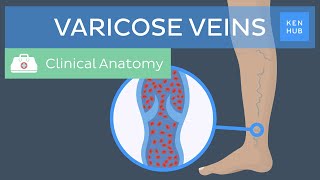 Varicose veins Definition causes symptoms and treatment  Kenhub [upl. by Gery]