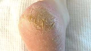 Severely Cracked Callused And Painful Heel Is Treated  Satisfying Skin Removal [upl. by Akiret]