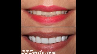 Cosmetic Dentistry Prepless Dental Veneers Before and After [upl. by Irallih956]