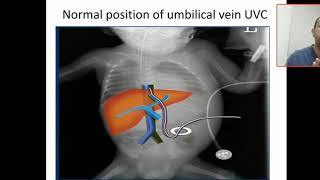 Case study 9 umblical venous catheter position and malposition [upl. by Dove]