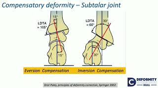 Compensatory theory of osteotomies around kneeEffect on Hip amp FampA alternate ways  H Sharma [upl. by Normalie]