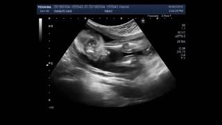 Ultrasound Video showing Club foot fetal anomaly scan [upl. by Quickel]