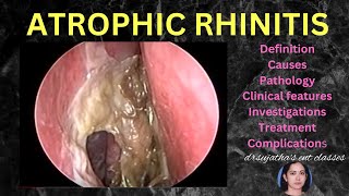 193Atrophic Rhinitis part 12 anatomylectures nose rhinitis anosmia smell [upl. by Meri]