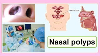 nasal polyps [upl. by Enecnarf283]