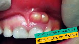 What causes an abscess [upl. by Kuska]