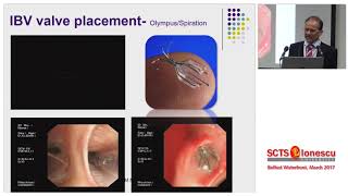 Endobronchial Therapies Will Make Surgery Obsolete [upl. by Atteyek]