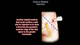 Glute injection buttock injection [upl. by Yesima]