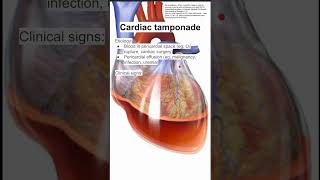 Cardiac tamponade [upl. by Drannek]