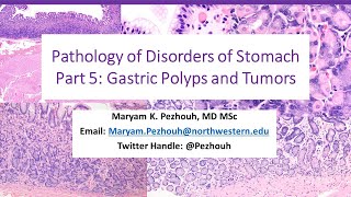 Part 5 Pathology of Gastric Disorders polyps and Tumors [upl. by Yleek]