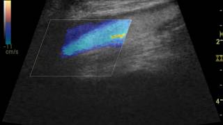 Vascular Ultrasound [upl. by Chinua]