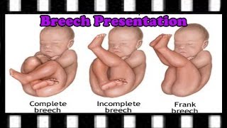 ICD9 Coding Question — 65221 Code amp Breech Birth Explained [upl. by Kaliope]