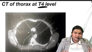 CT Of Thorax at T4 level CT scan of Thorax by Rao medical academy [upl. by Katti835]