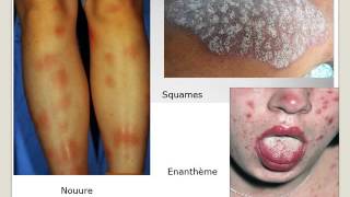 INFECTIOLOGIE Eruption cutanée 2016 [upl. by Ainig]