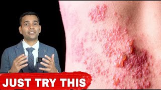 Try This If You Are Suffering From Shingles  Herpes Zosters   Dr Vivek Joshi [upl. by Nehpets215]