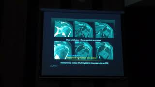 Imagerie  Diagnostic radiologique dune lésion de la coiffe [upl. by Melquist412]