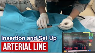 Arterial line insertion and set up for invasive blood pressure monitoring [upl. by Oicinoid834]