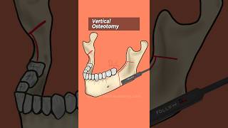 BSSO Bilateral Sagittal Split Osteotomy Animation drteeth dentistry [upl. by Saxen305]