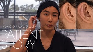 Revision Otoplasty For Prominent Ear Correction  Ear Fold Surgery Patient Testimonial [upl. by Novehc346]