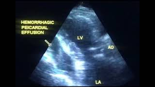 Pericardial effusion or hemopericardium to drahmadmirdamadisi4YcoVxIYKdkLrw2q [upl. by Aelhsa]