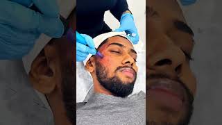 කුරුලෑ වලවල් සදහා subcision with microneedling ප්‍රතිකාරය 🧚🌸skincare doctor foryou [upl. by Neel]