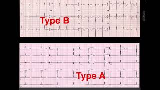 Advanced EKGECG interpretation  STEMI equivalents [upl. by Ferri]