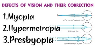 Myopia Hypermetropia Presbyopia DEFECTS IN HUMAN EYE AND THEIR CORRECTION Class 10 physics [upl. by Ultan]