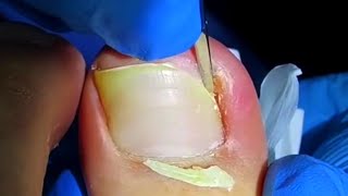 Dig Out Huge Ingrown Toenail By Professional [upl. by Magas]