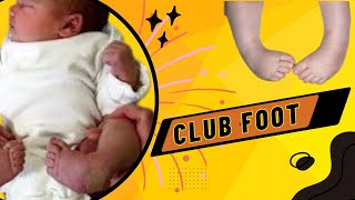 Talipes Equinovarus  Club Foot  Causes Symptoms Diagnosis and Treatment [upl. by Tavia]